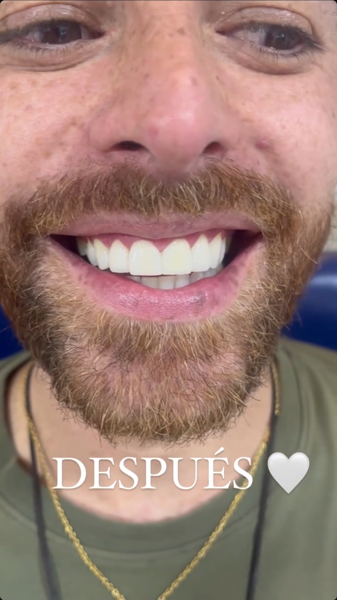 Diseño de sonrisa — resultado con carillas