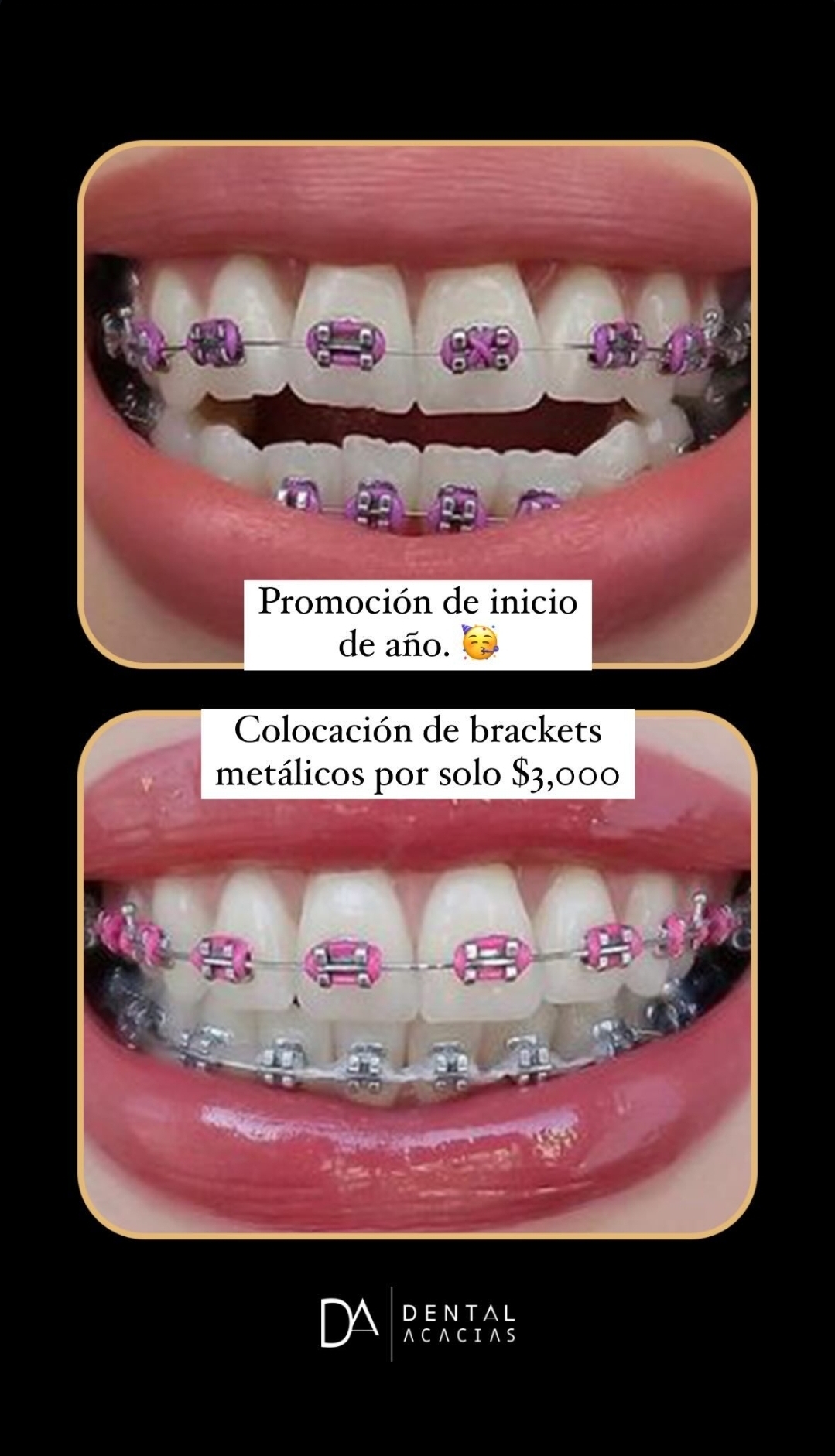 Ortodoncia Invisalign — antes y después
