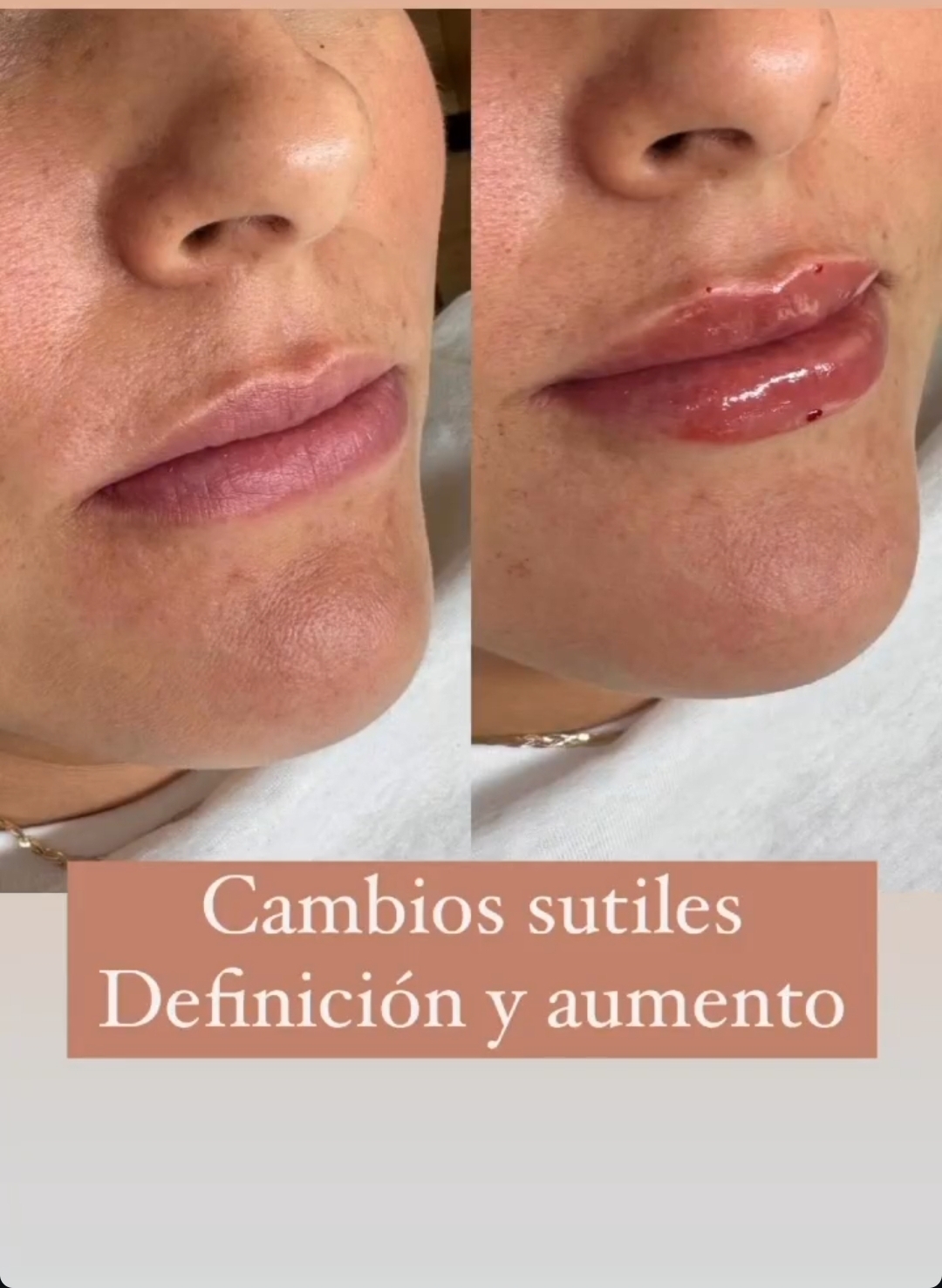 Rellenos de labios — cambios sutiles