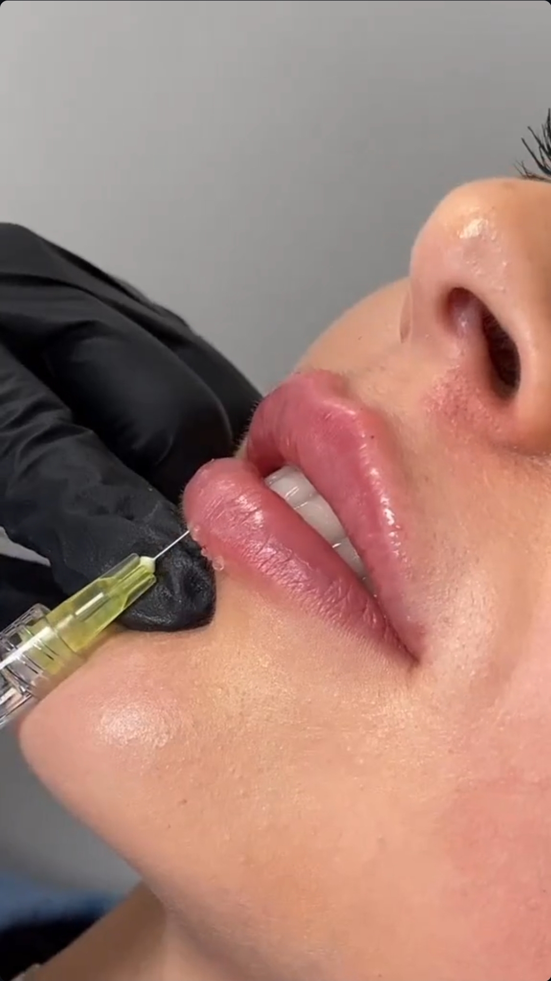 Proceso de inyección de labios