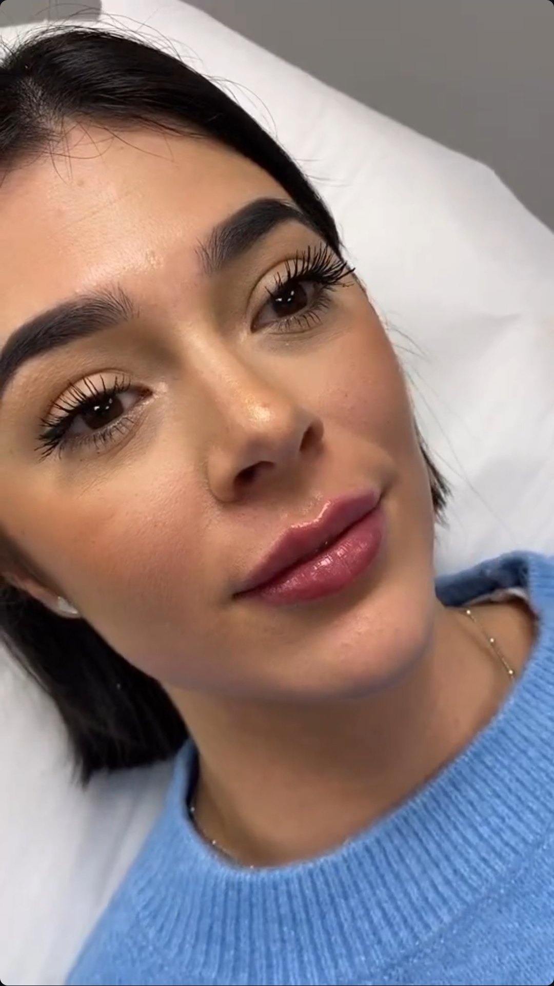 Armonización facial — labios con ácido hialurónico