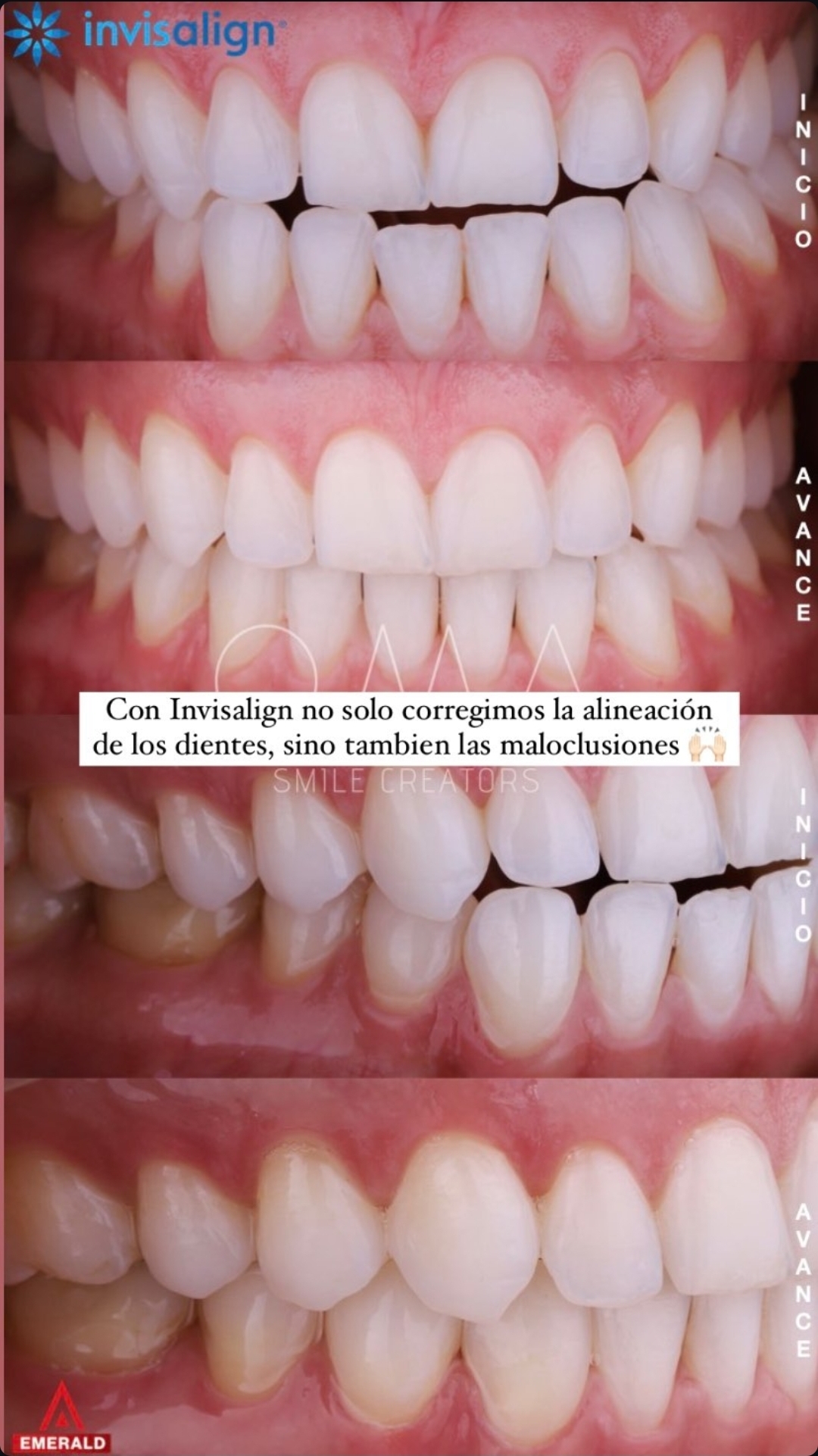 Después del tratamiento Invisalign