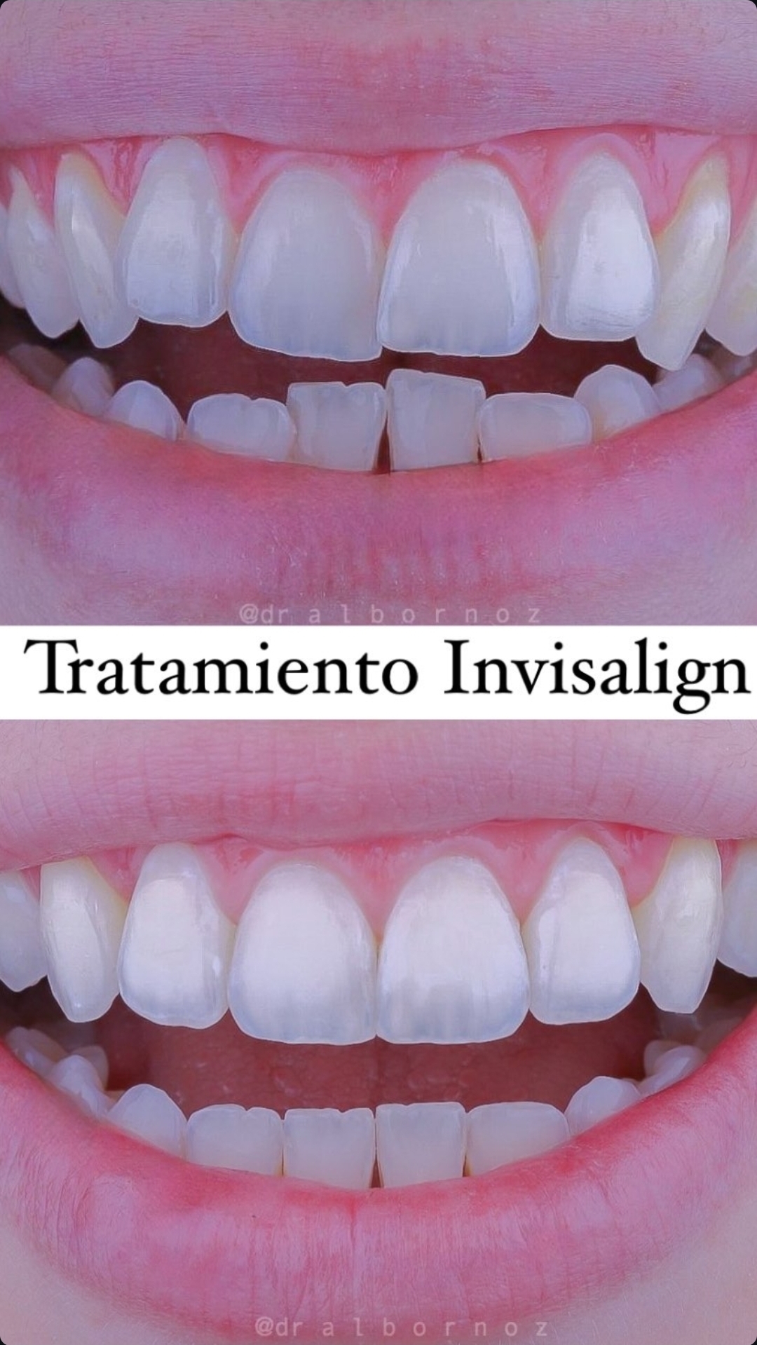 Caso Invisalign — transformación real